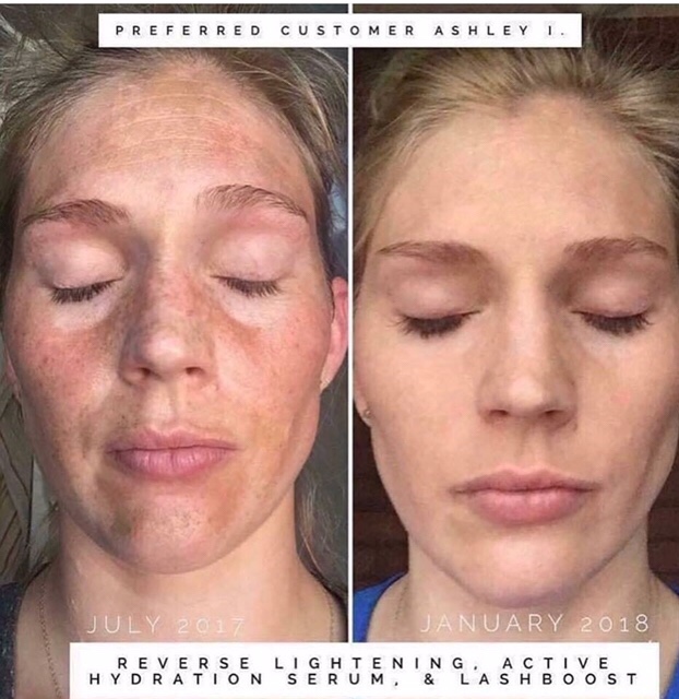 Rodan + Fields Before and After Photo w